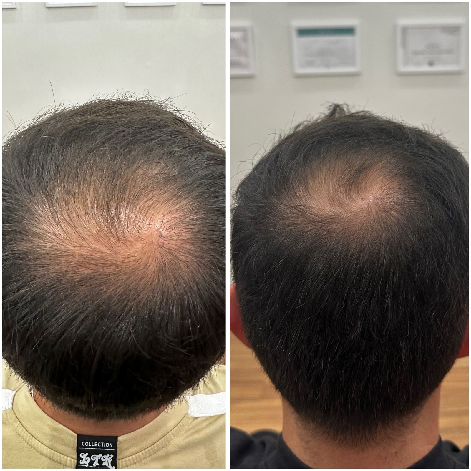 Antes e depois - protocolo de alopecia androgenética