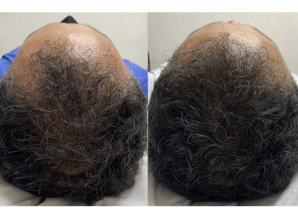 Antes e depois - alopecia androgenética masculina