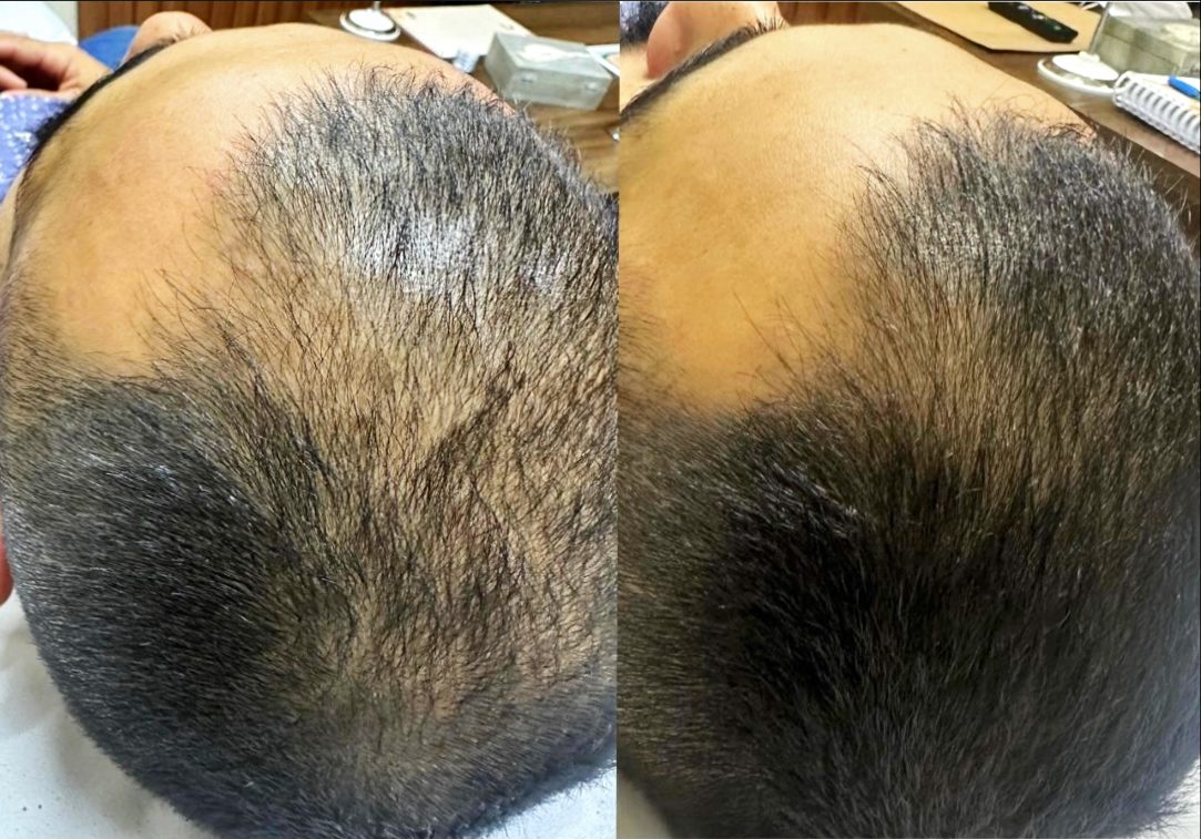 Antes e depois - alopecia androgenética masculina