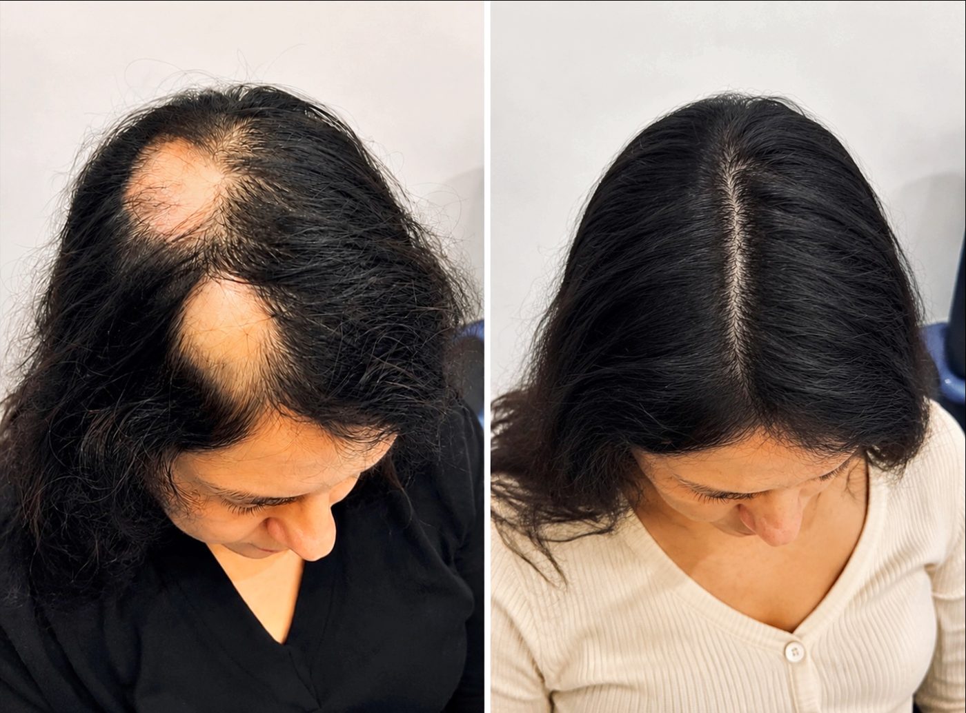 Antes e depois - alopecia areata feminina