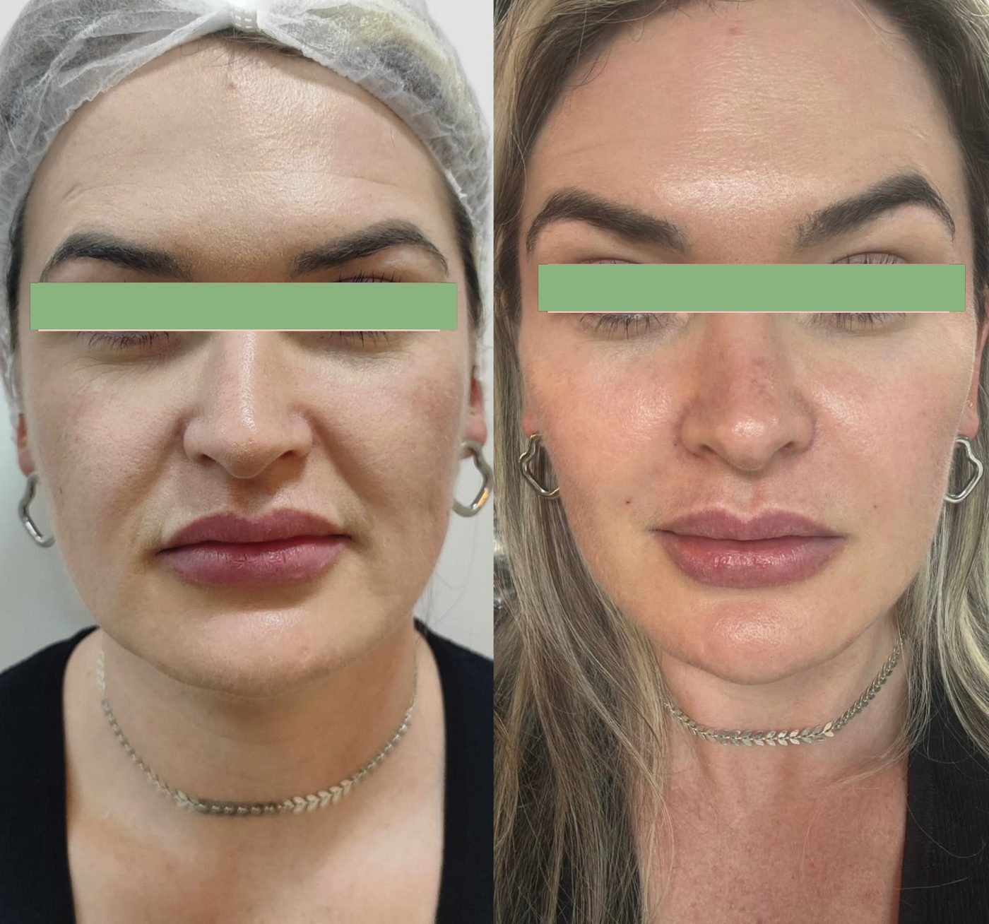Antes e depois - preenchimento facial full face